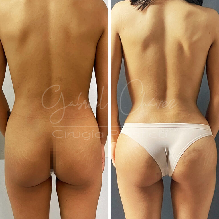 aumento-de-gluteo-caso-2