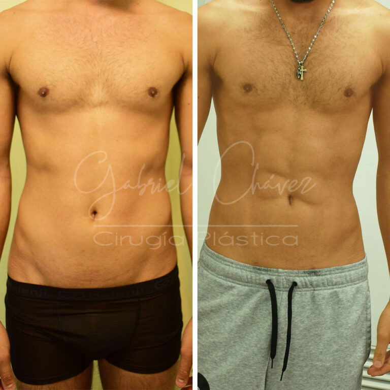 lipoescultura-hd-hombre